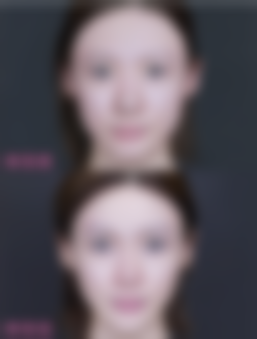 北京米兰柏羽丽都医美于晓春医生做美杜莎6.0豪华A版眼综合12740元起，微创个性技术+靠谱医院团队，让你轻松拥有迷人电眼！ 