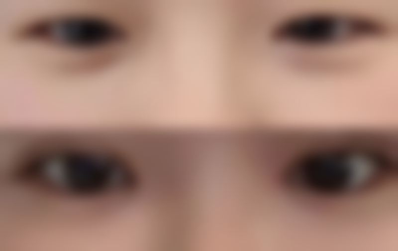 瘦脸针100单位够打两边吗