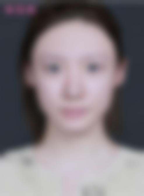 北京米兰柏羽丽都医美高嵩医生做乔雅登丰颜+朔颜玻尿酸各1mL套餐28720元起，性价比超高助你轻松拥有精致立体面容！ 