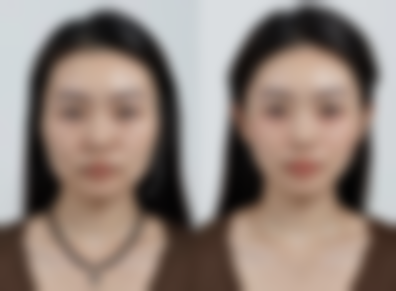 下巴整形修复过程图片