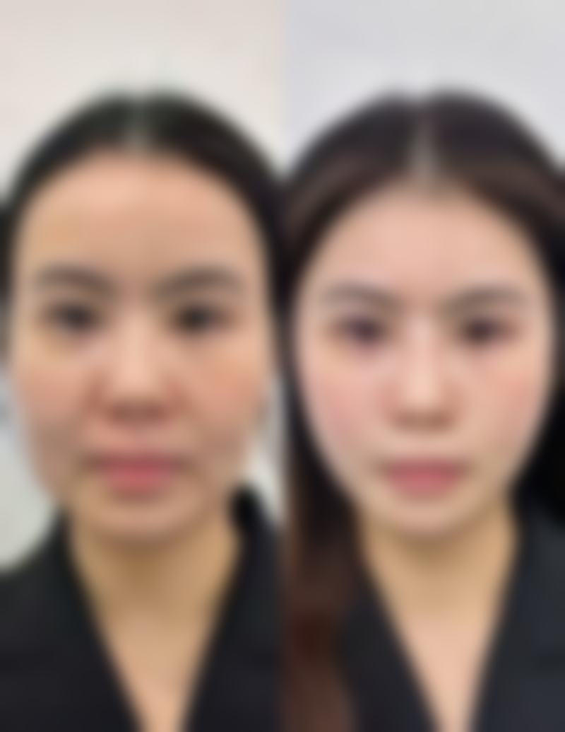 种植头发真的可以自然生长吗