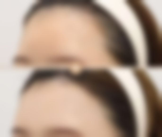 张嘴睡觉导致的凸嘴图片及照片