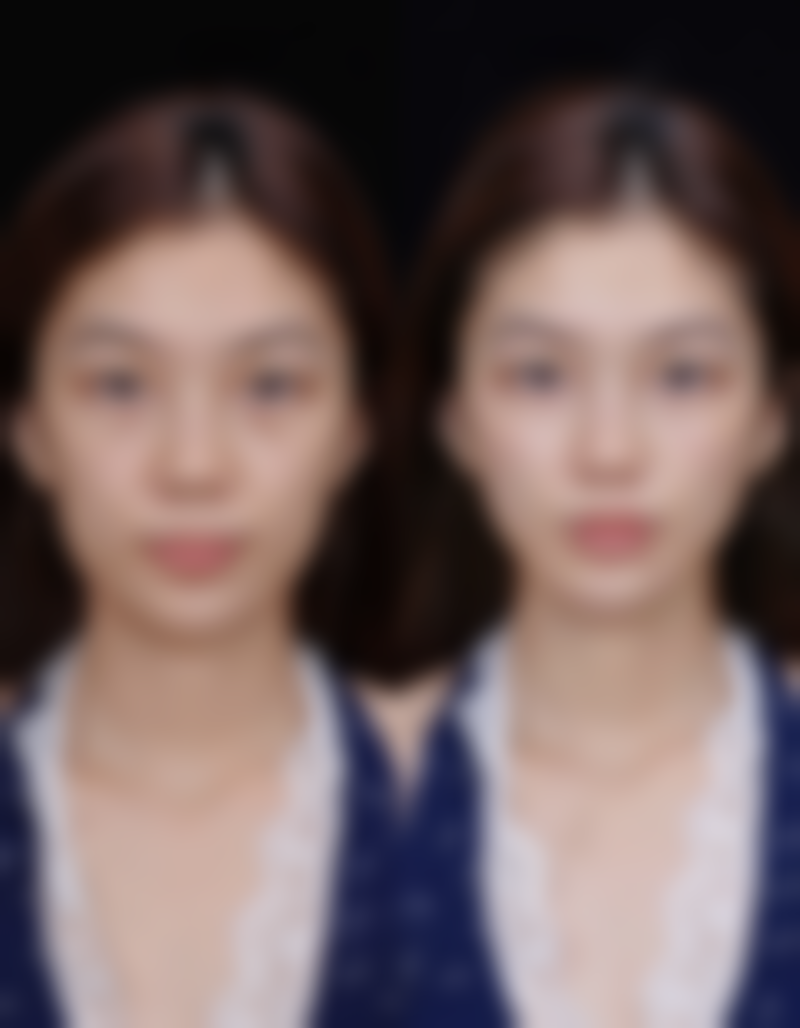 张嘴睡觉导致的嘴巴凸还能矫正吗