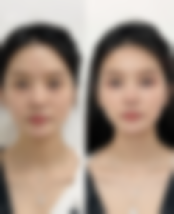 阴道紧缩术的术前和术后注意事项