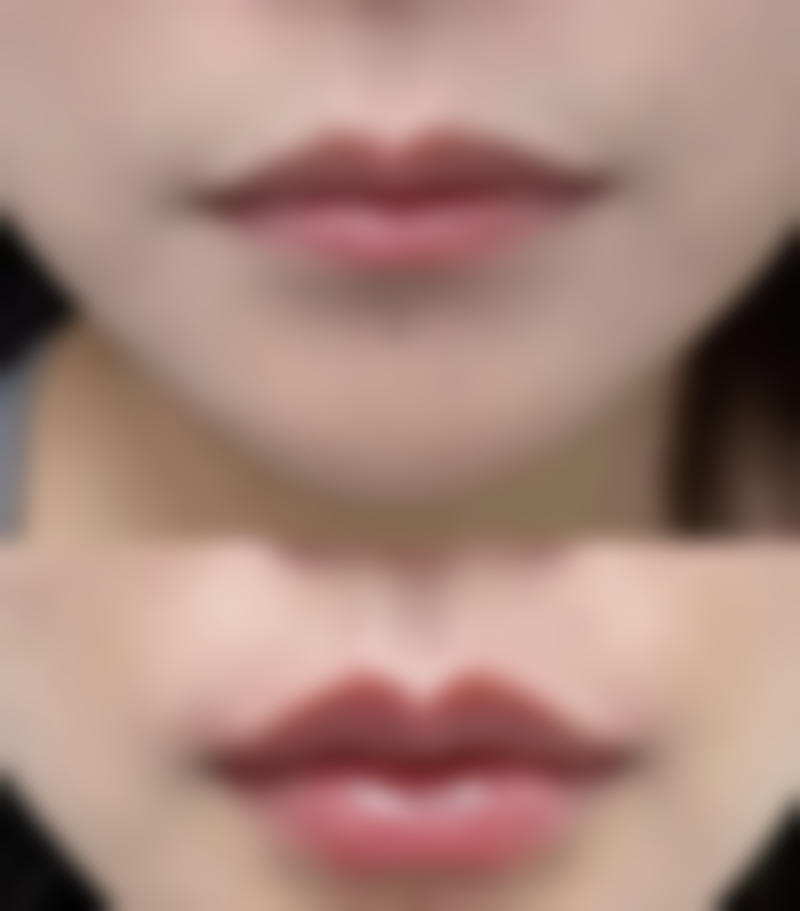 打了美白针一定可以白吗