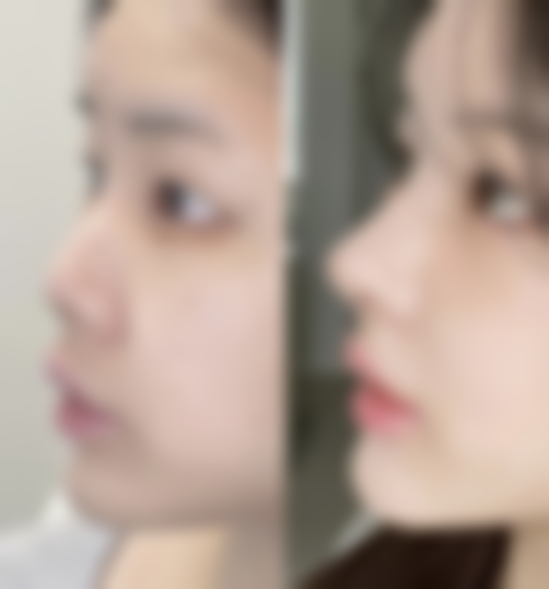 打瘦脸针的注意事项