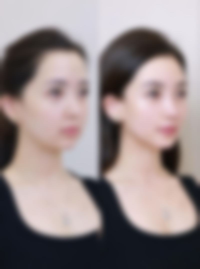 瘦脸针打了五六次还有成效吗