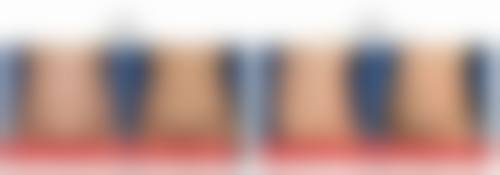 咬肌大不打瘦脸针怎么瘦下来