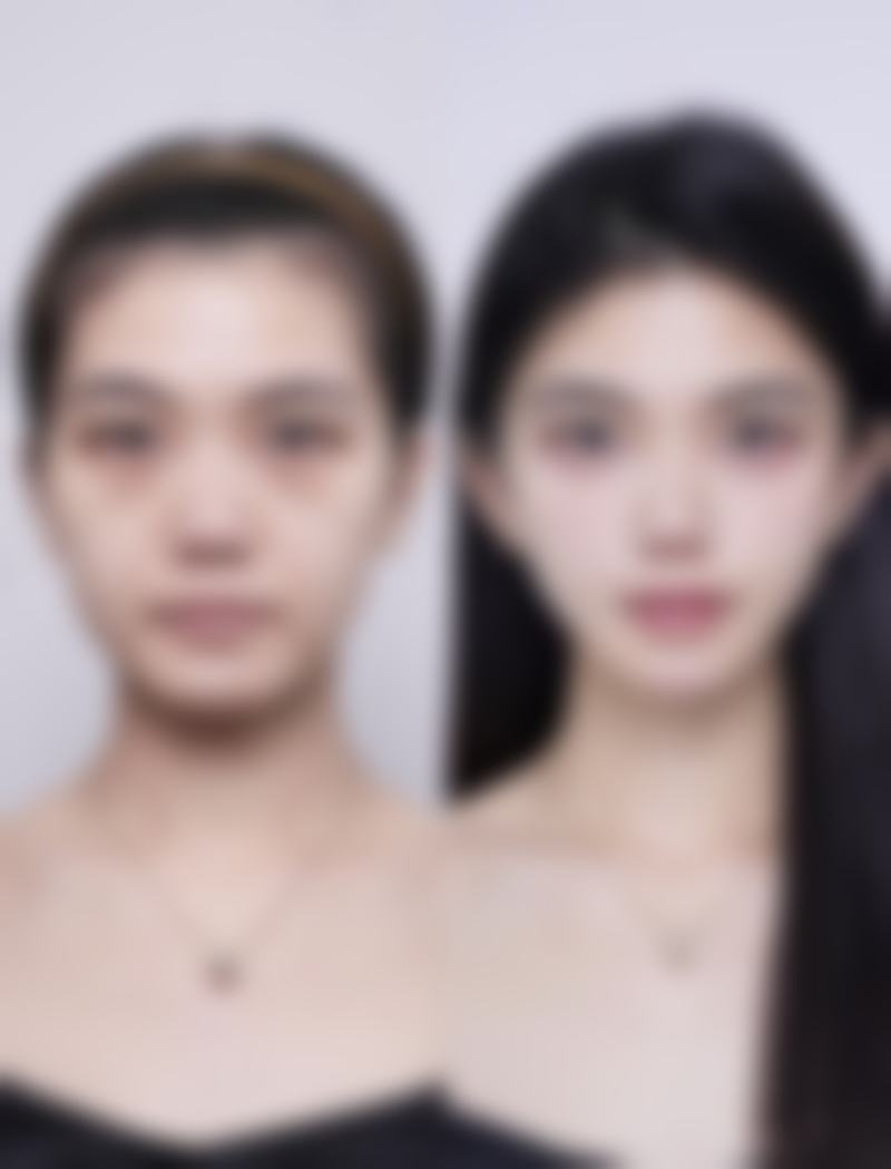 瘦脸针的作用原理