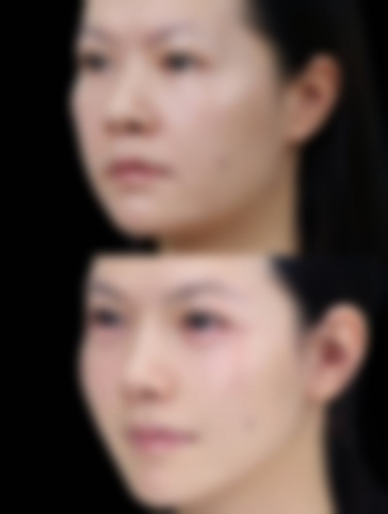 不同部位皱纹的去除方法