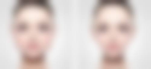 小孩腺样体肥大上嘴唇突出怎么办?