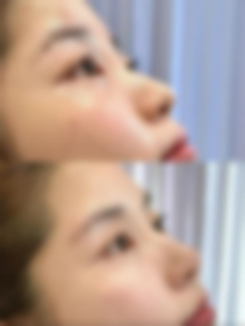 瘦脸针可以去不同的医院打吗