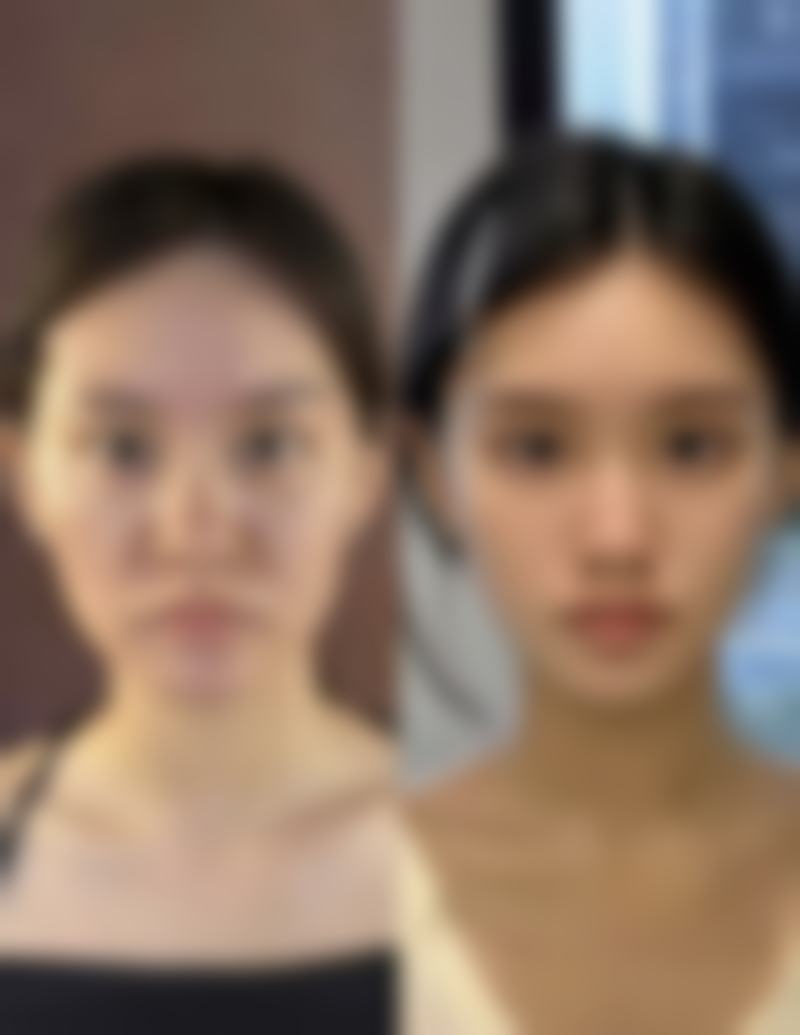 阴道紧缩术有成效么？