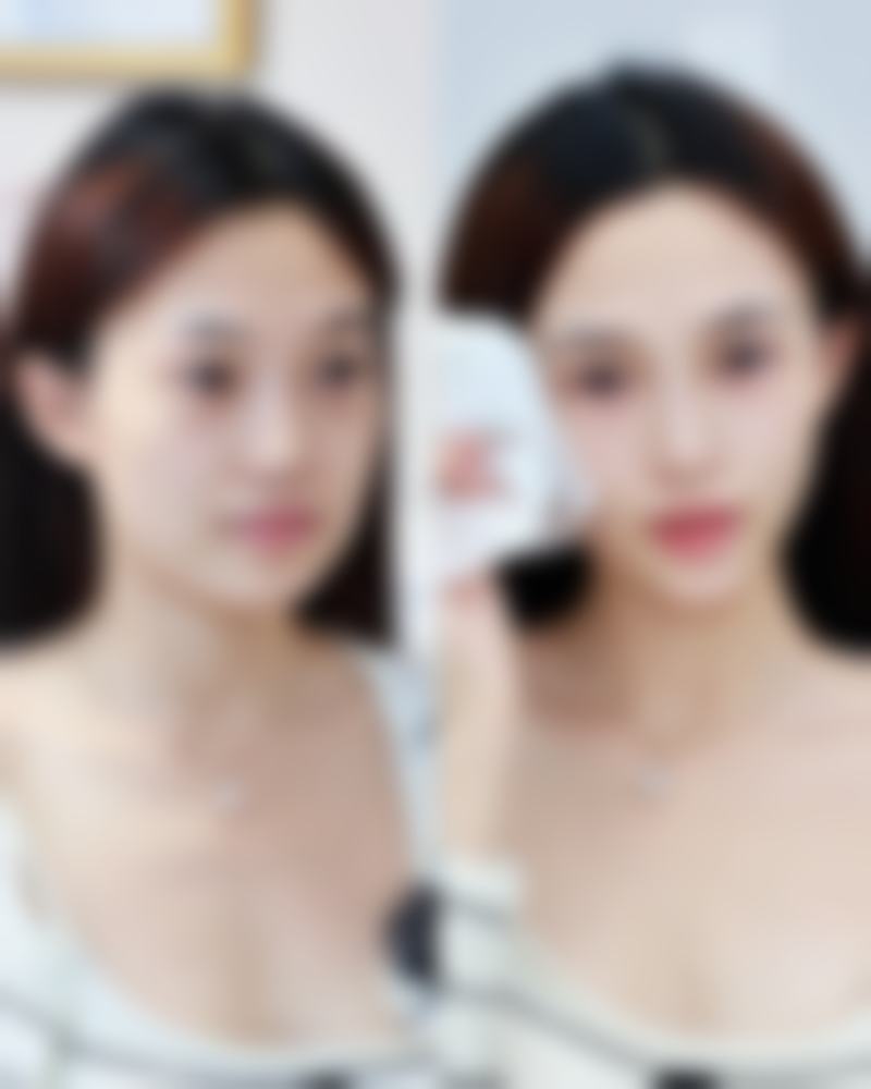 阴道紧缩术效果明显吗？权威数据揭示术后满意度超 80%，改善生活质量效果看得见！ 