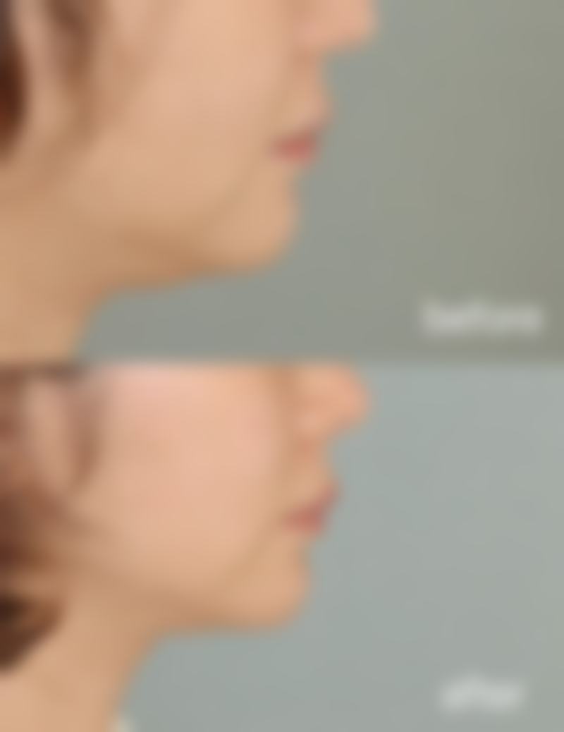 打瘦脸针后还能修复原来的样子吗