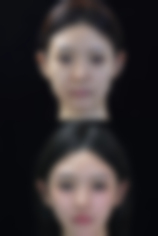 打瘦脸针后会没成效吗