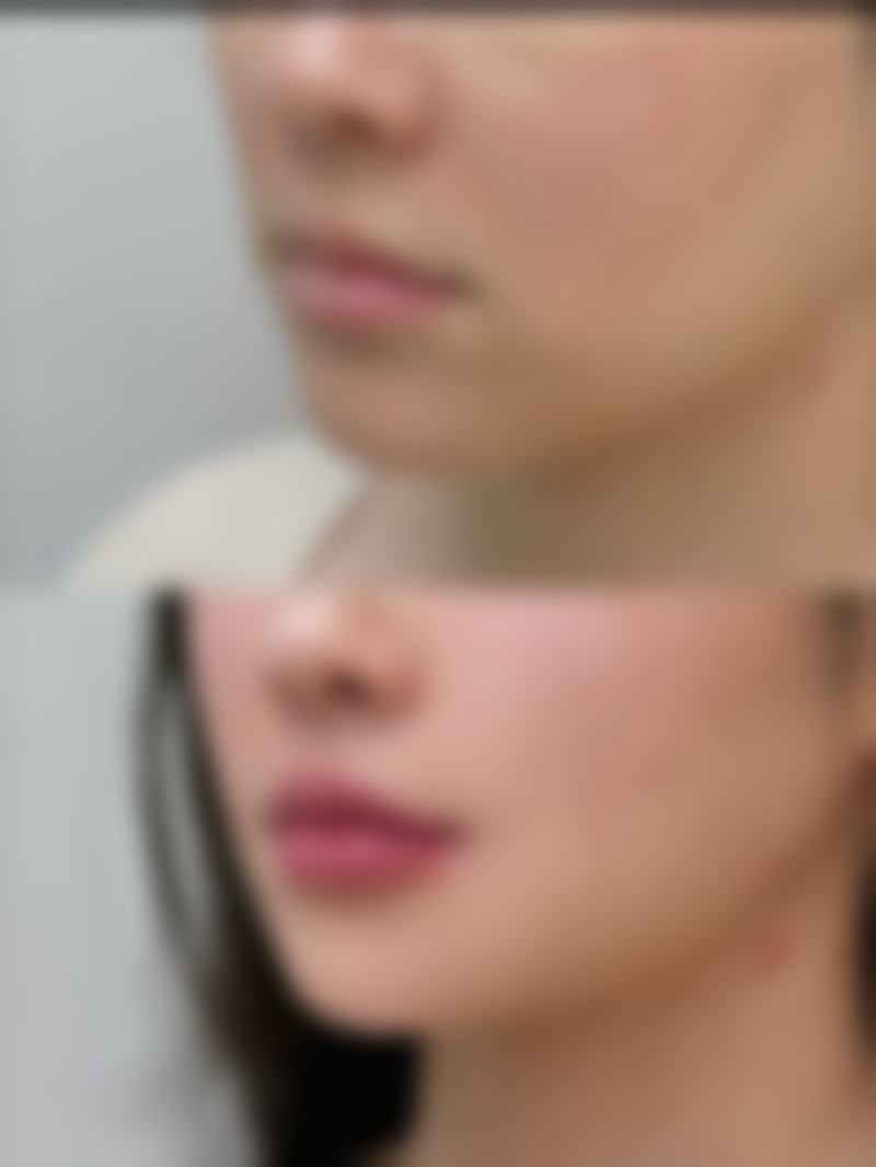 瘦脸针的面部凹陷会越来越重度吗