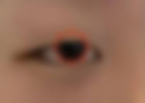 小阴唇缩小的意义