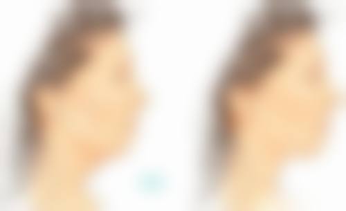 打瘦脸针要多久才能看到效果？了解3大关键因素，最快1周见证小V脸奇迹！ 