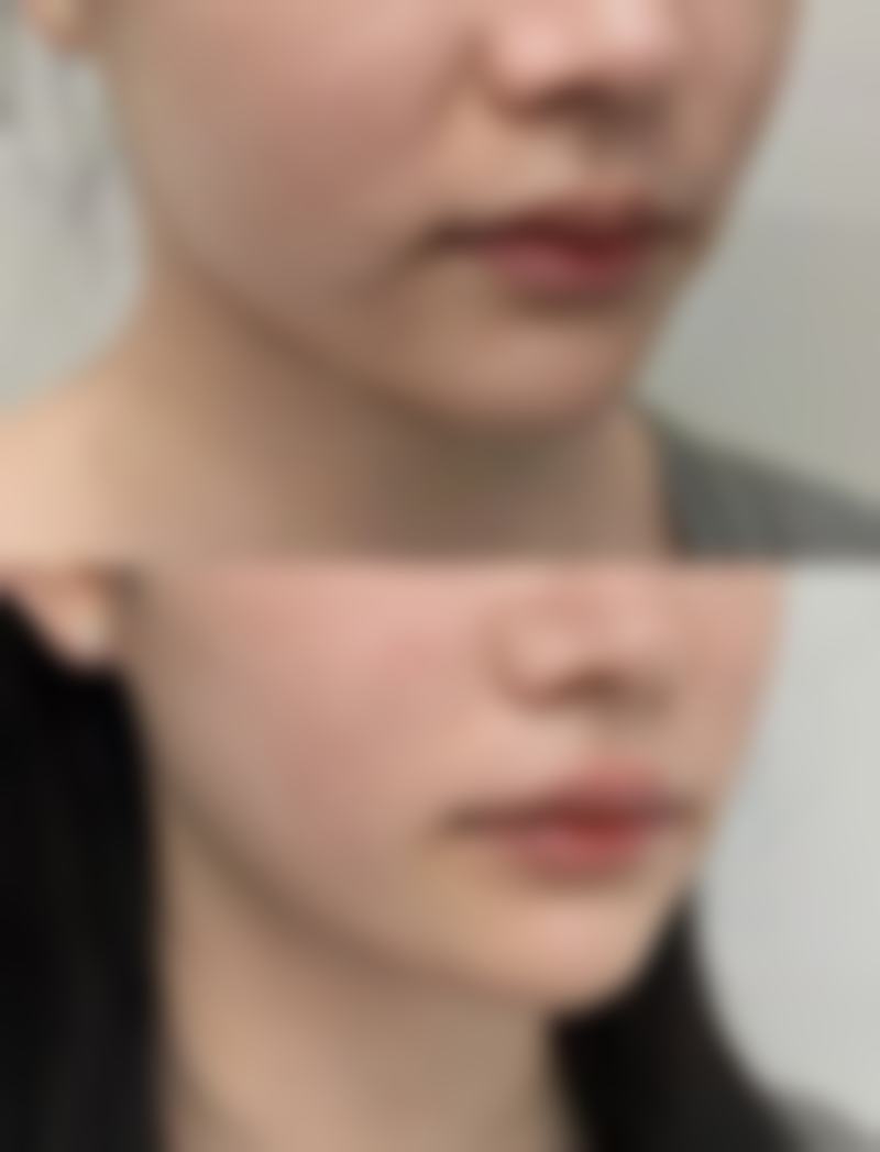 做完光子嫩肤多久可以打除皱针