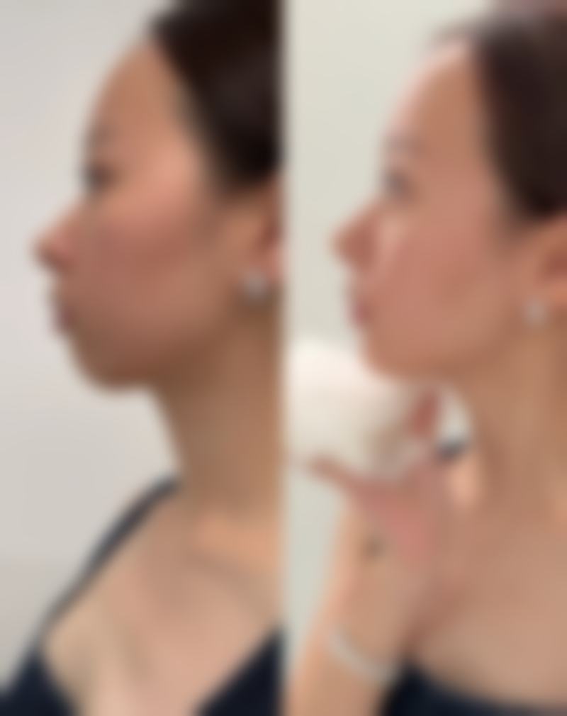 阴式子宫切除 + 阴道前后壁修补术