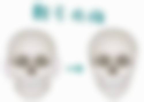 打多少次瘦脸针相关问题解答