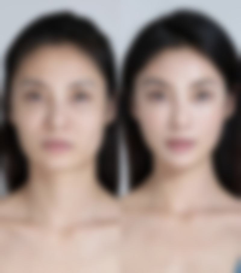 瘦脸针一边可以打 60 单位吗