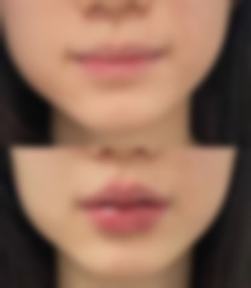 瘦脸针一针可以打两边脸吗