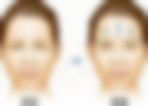 打瘦脸针会垮脸吗