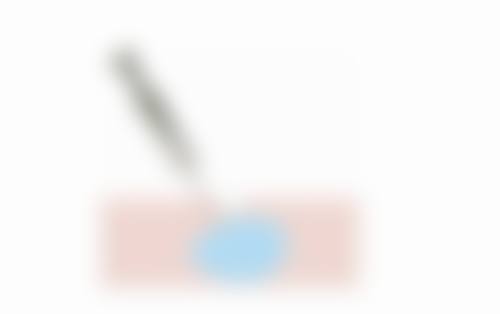 做盆底肌修复下面会变紧吗