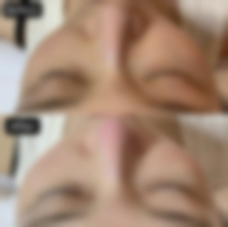瘦脸针为什么不能抽烟？了解这3大原因，助你知晓术后护理要点，保障瘦脸效果！ 