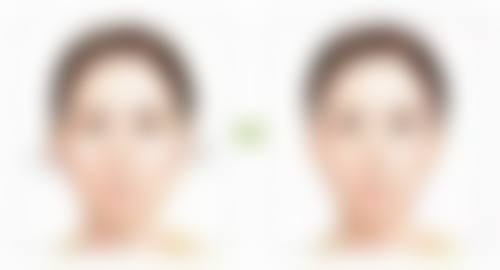 打了瘦脸针能维持多久