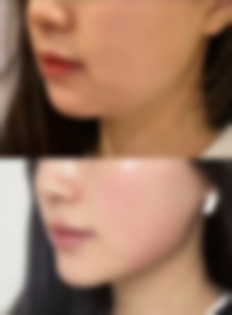 瘦脸针打完多久成效更明显