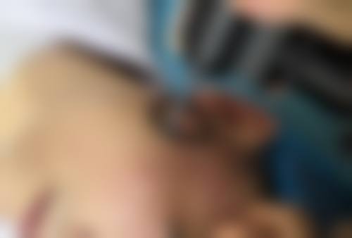 瘦脸针打了脸会凹陷吗