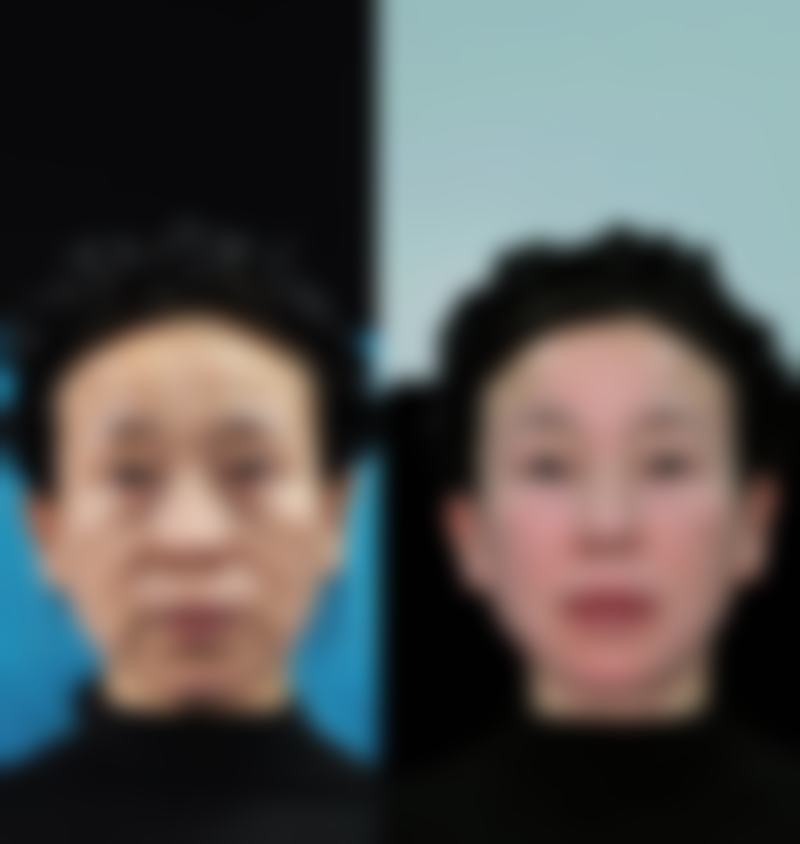 种植发际线2000个单位有多少