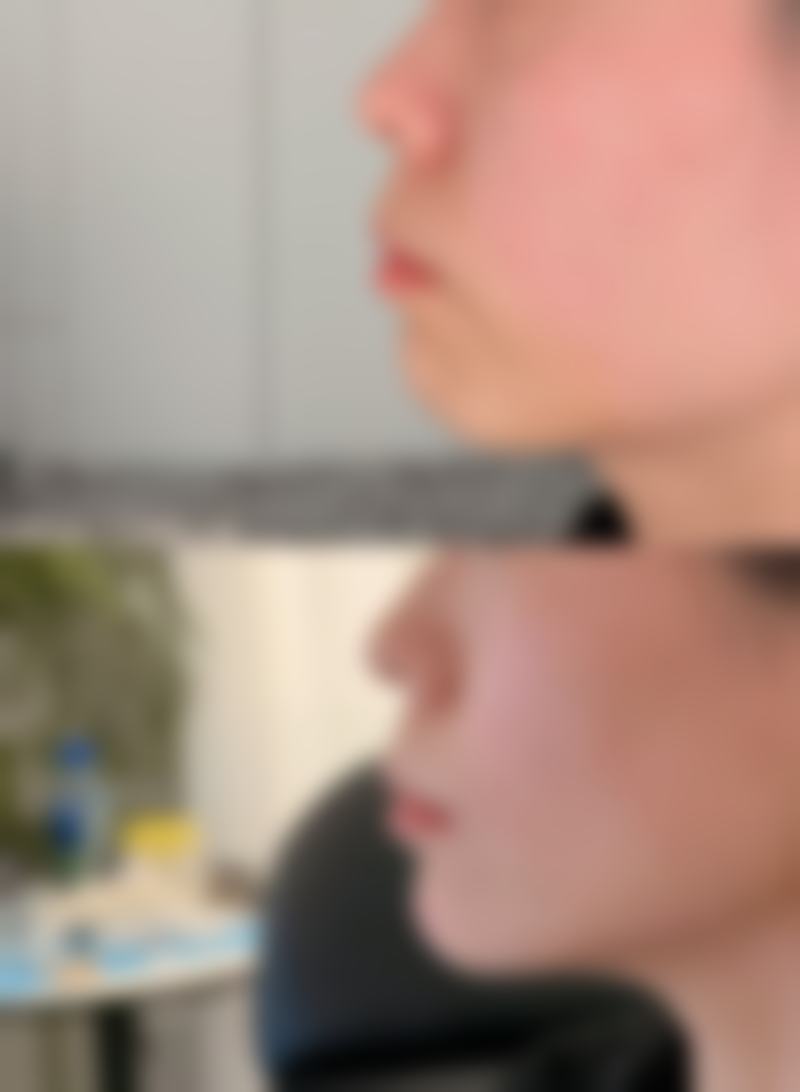 瘦脸针第一针和第二针
