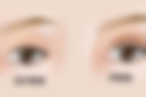 阴道紧缩术有几种方法