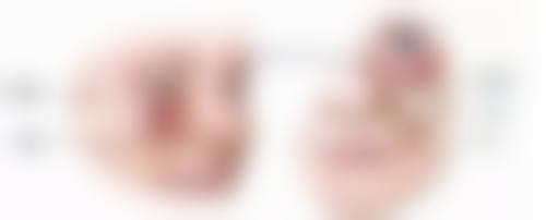 如何选择适合自己的阴道紧缩术方法