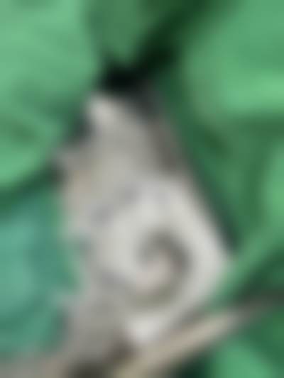 S女性医院李惠妍手术成功几率高靠谱吗？