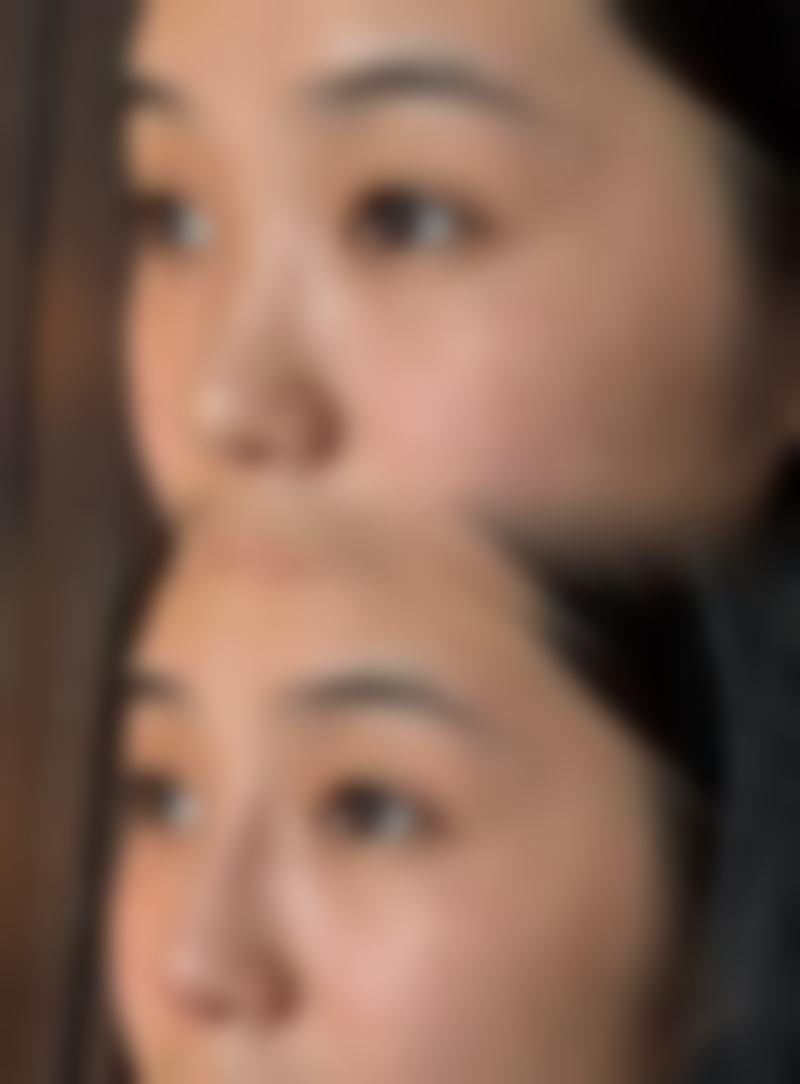 射频除皱有副作用吗