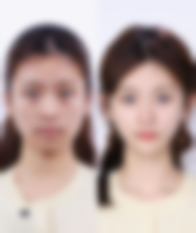 阴道紧缩术的价格情况