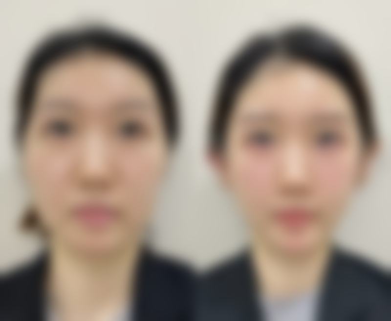 阴道紧缩术有几种方法