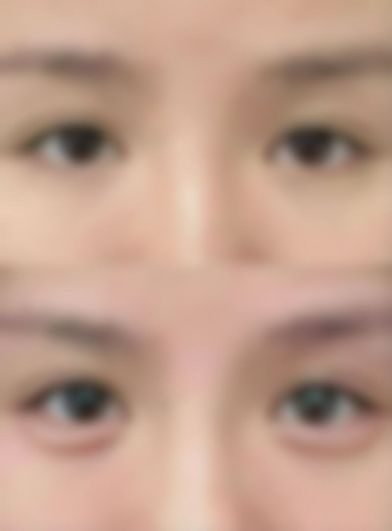 阴道紧缩术怎么操作