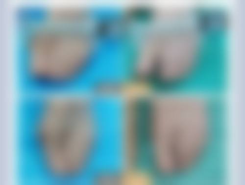 除皱针多久可以见到成效