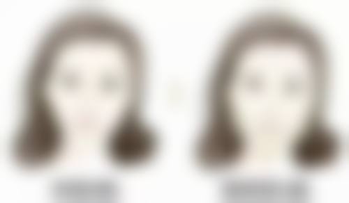 打除皱针有什么副作用