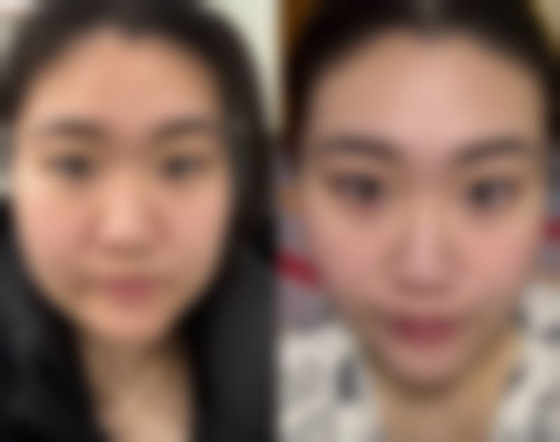 在医院的设备方面，精良的皮肤检测设备能够全方面地检测皮肤的状况。比如，它可以检测皮肤的水分含量、弹性、色素沉着等情况，为医生提供详细的诊断信息。治疗设备则能够根据不同的皮肤问题进行针对性的治疗。例如，激光治疗设备可以用于去除色斑、痘印等皮肤瑕疵，还可以刺激皮肤胶原蛋白的再生，使皮肤更加紧致有弹性。