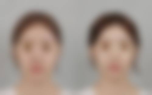 打完瘦脸针什么时候可以洗脸化妆