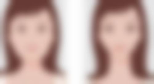 双下巴能打肉毒杆菌吗？