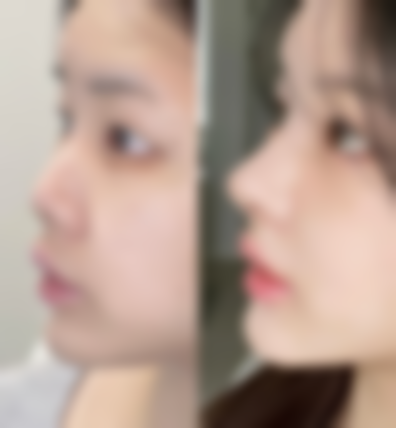 面部除皱的几种方法