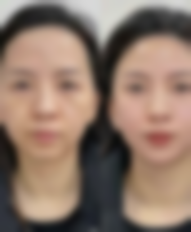 双下巴打瘦脸针管用吗？